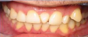 Best Dentist in dhaka-Dental Bridge