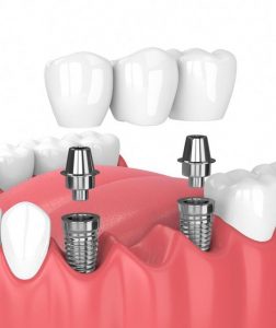 Best Dentist in Dhaka -Dental Implants
