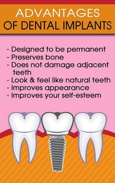 Best Dental Implant,