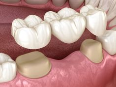 Best Dentist in dhaka-Dental Bridge