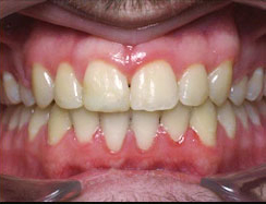 Teeth Braces Cost In Bangladesh - [Detail Price List] - Dental Clinic Info  - Best Dentist - Dental Hospital Doctor List