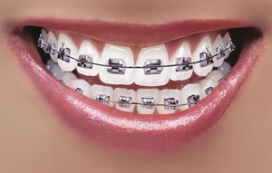 Best Dentist in Dhaka-Orthodontics