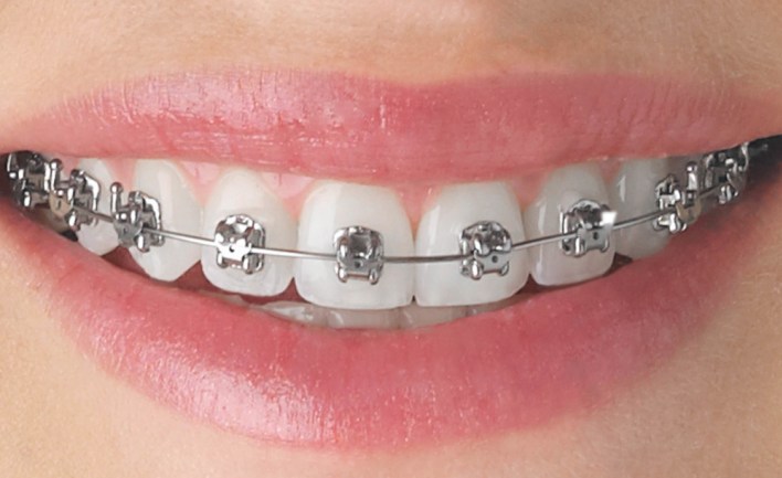 Teeth Braces Cost In Bangladesh - [Detail Price List] - Dental Clinic Info  - Best Dentist - Dental Hospital Doctor List