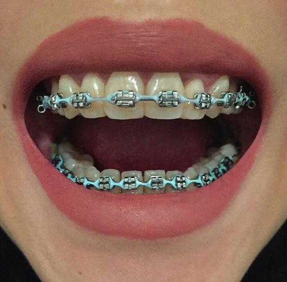 Teeth Braces Cost In Bangladesh - [Detail Price List] - Dental Clinic Info  - Best Dentist - Dental Hospital Doctor List