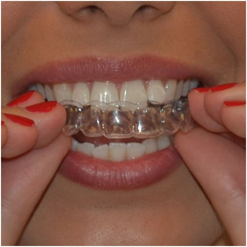 Teeth Braces Cost In Bangladesh - [Detail Price List] - Dental Clinic Info  - Best Dentist - Dental Hospital Doctor List