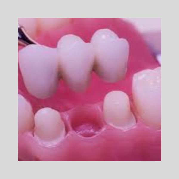 Services 4 Dental Bridges
