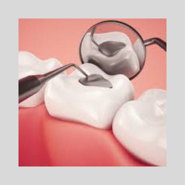 Services 5 Dental Filling