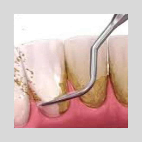 Services 7 Dental Scalling