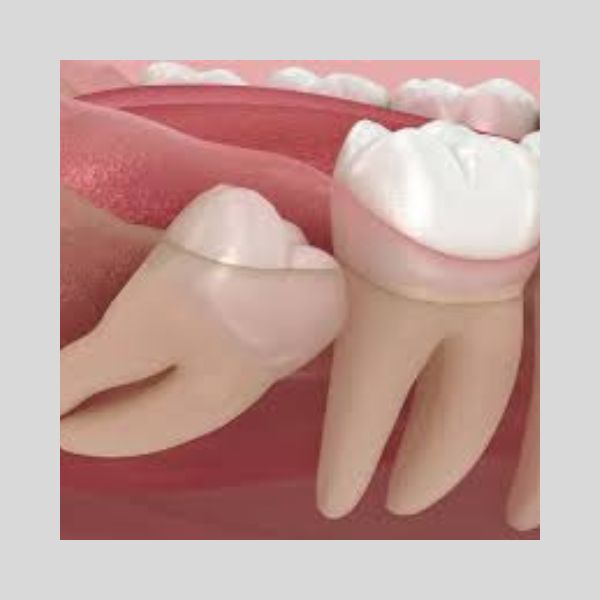 Wisdom Teeth Removal 1 Wisdom Teeth Removal